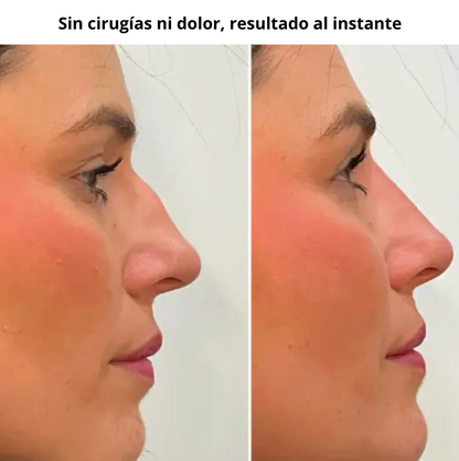 Corrector de Nariz